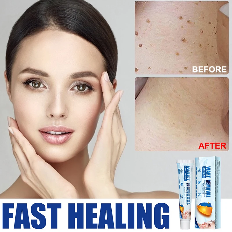 Newly Wart Remover Cream Skin Tag Removal Treatment with Natural Ingredients Body Supply |