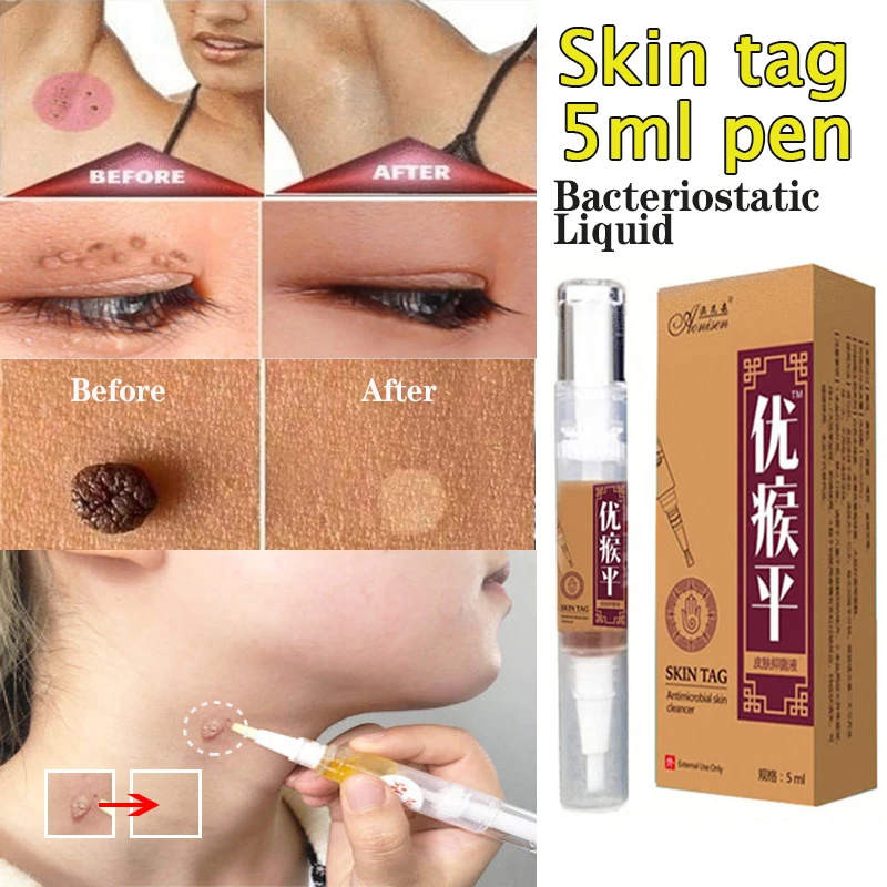 Набор для удаления бородавок на ногах антибактериостатический набор быстрого и