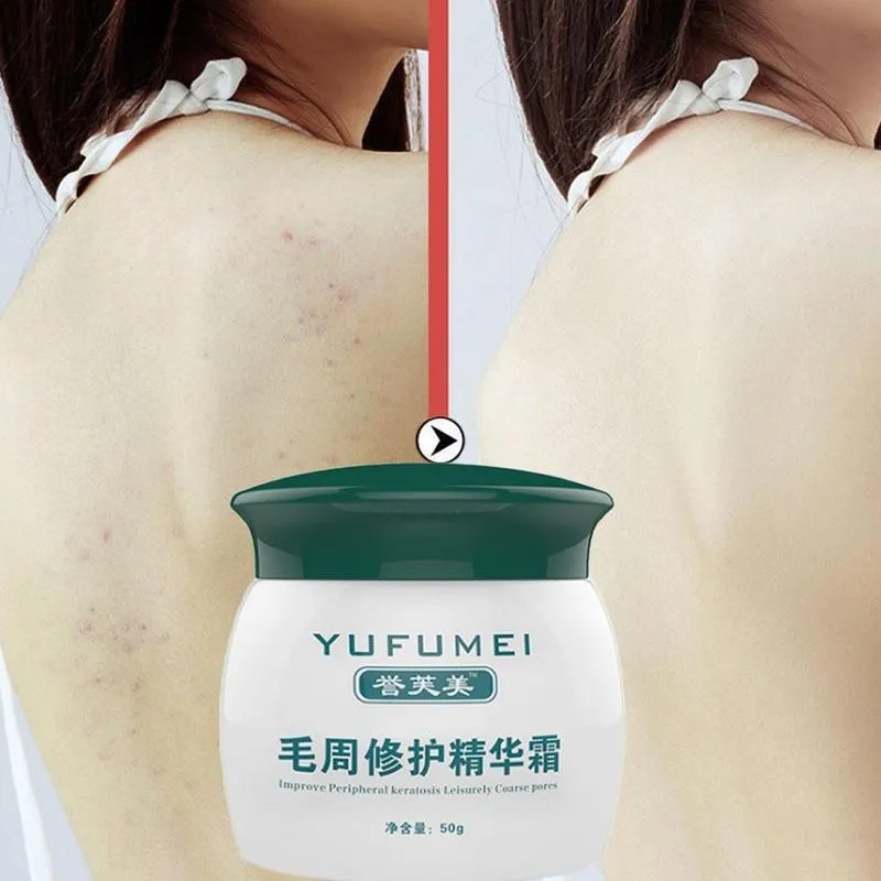 Новый Лидер продаж крем для восстановления кожи и тела 50 г лечение кератоза Pilaris/