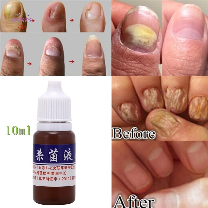 

Nail Protector Skin Care Cream Nail Fungus Treatment Herb Nails Repair Cream Nail Care Tools High Quality hot