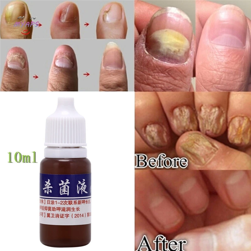 Средство для защиты ногтей крем ухода за ногтями Лечение грибка травы