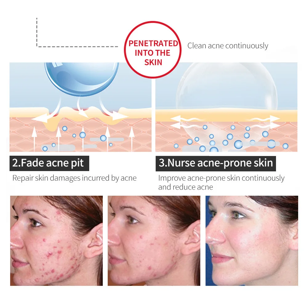 

Anti Acne Removal Essence Remover Pimple Repair Shrink Pores Face Skin Care 40ml KG66