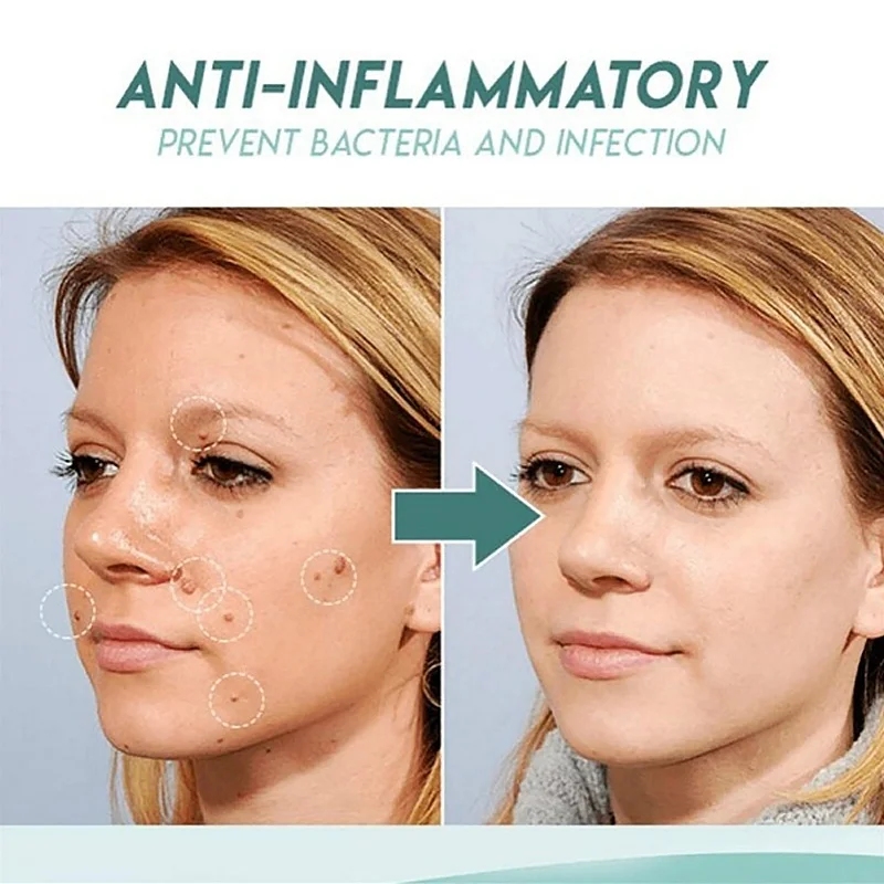 

Warts Warts Flat Warts Skin Repair No Trace Beauty Papilloma Pen Of Removal Skin Mole Liquid Warts Treatment