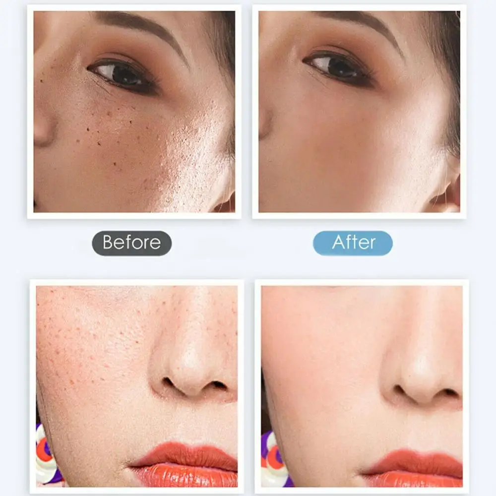 Средство для удаления кожи с биркой инструменты ухода за кожей бородавка родинка