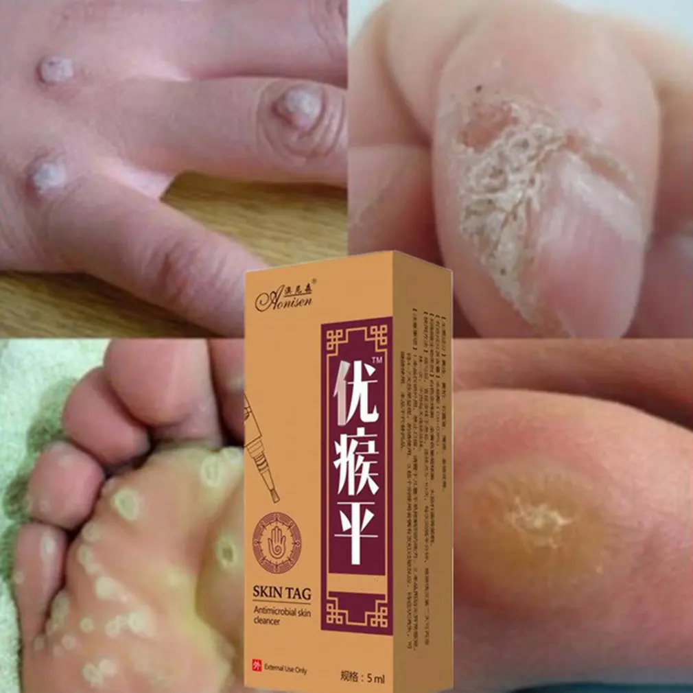 Средство для удаления бородавок папилломы Быстрое Удаление родинок