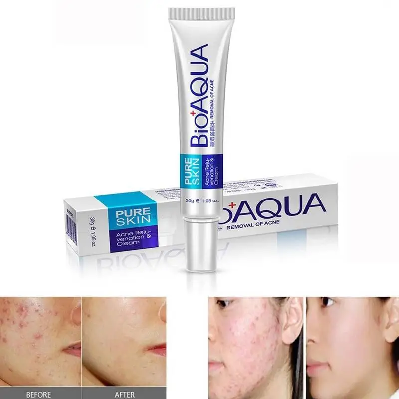 30g Acne Treatment Blackhead Remova Anti Acne Cream Oil Control Shrink Pores Acne Scar Remove Face Care Whitening