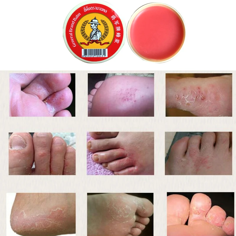 5 шт. тайская мазь для отверждения тинеа упрямого псориаза экзема Гонконг у