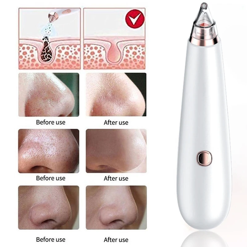 Средство для удаления черных точек вакуумное оборудование косметический