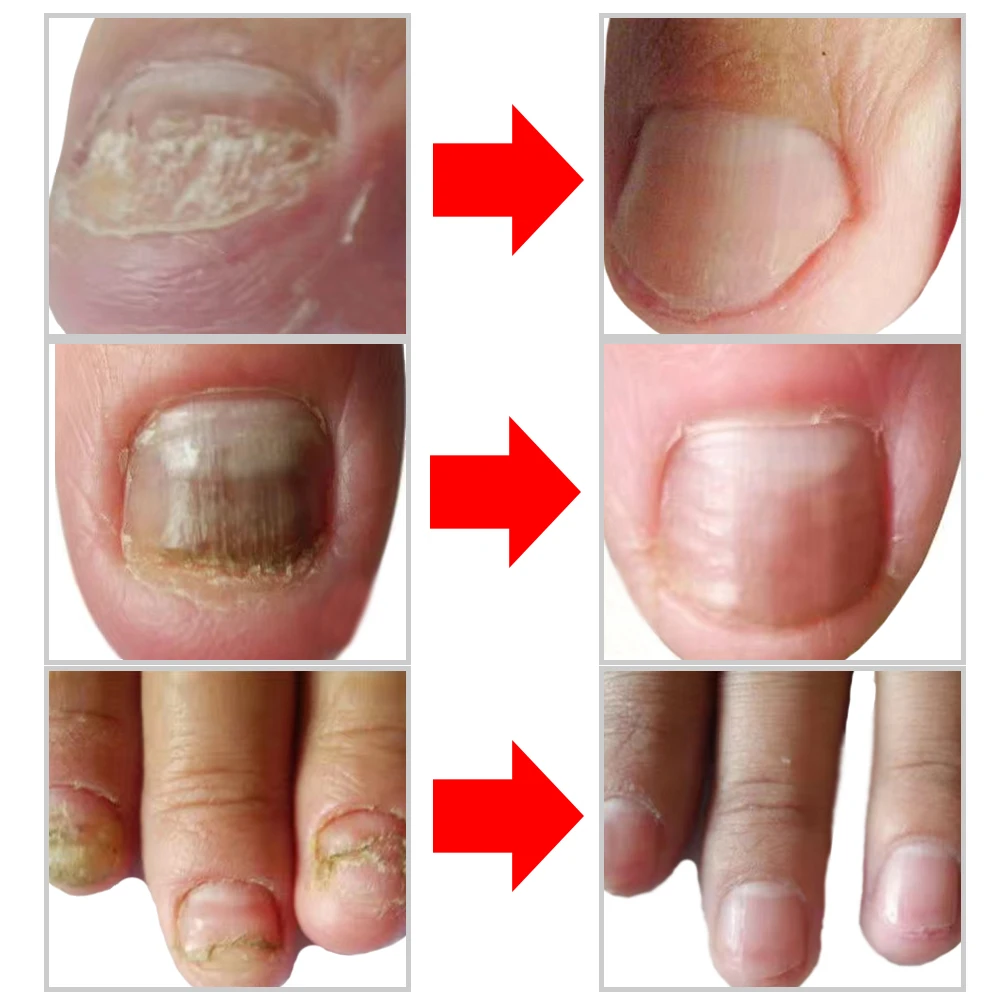 Противогрибковая Сыворотка для ногтей уход восстановление эссенция паронихия