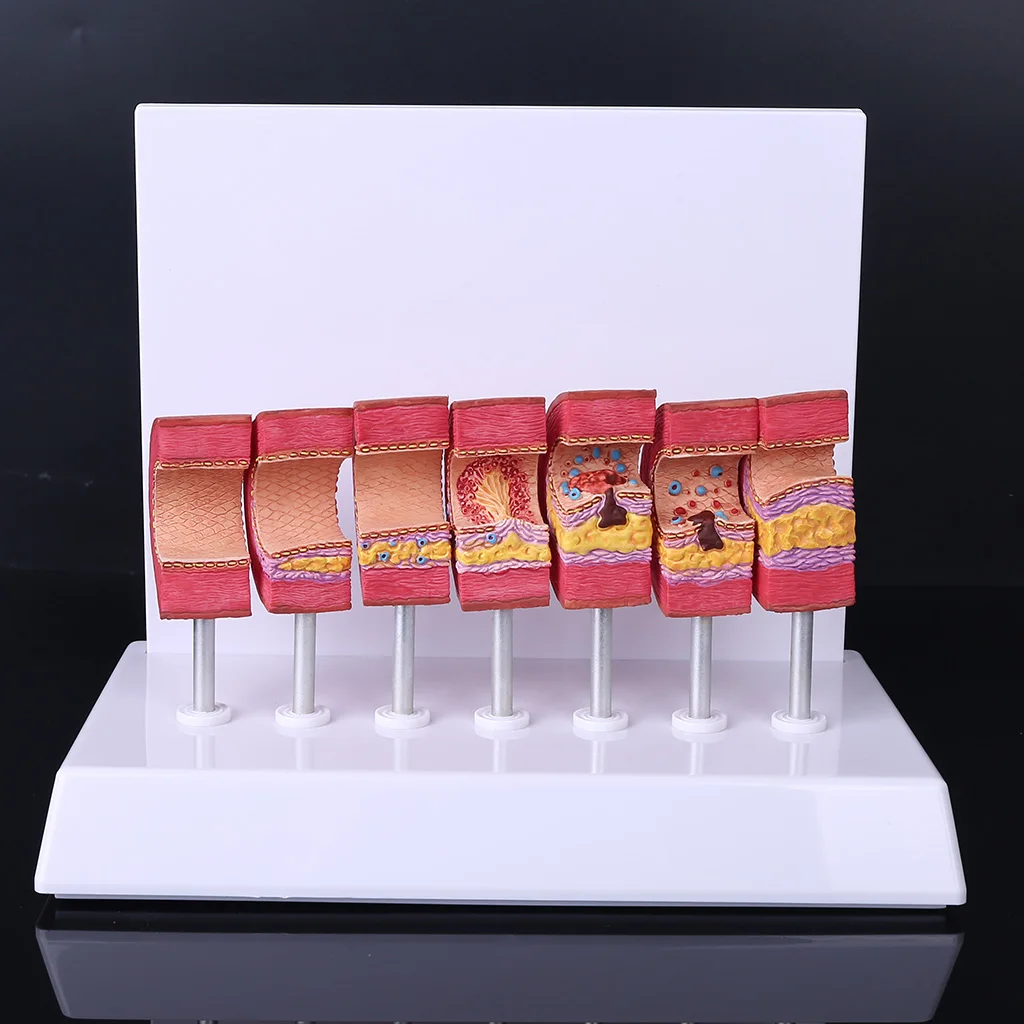 

Brand New and High Quality Human Atherosclerosis Model Artery Pathology Anatomical Blood Vessel Anatomy Thrombus Blood Fat