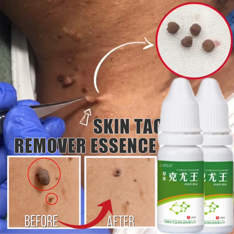 10ml Skin Tags Remove Liquid Treatment Foot Corn Papillomas Mole Plantar Warts Removal Neck Armpit Skin Tag Health Care Tool