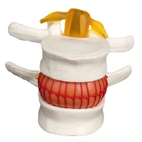 human lumbar model anatomical disc herniation medical learn aid instrume teaching training aid