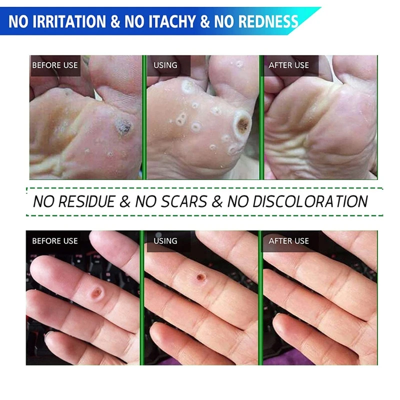 

K0AE Corn Remover Pads, Remove Corns Fast, One Step Pads, Cushioning Protection Against Shoe Pressure, Release Feet