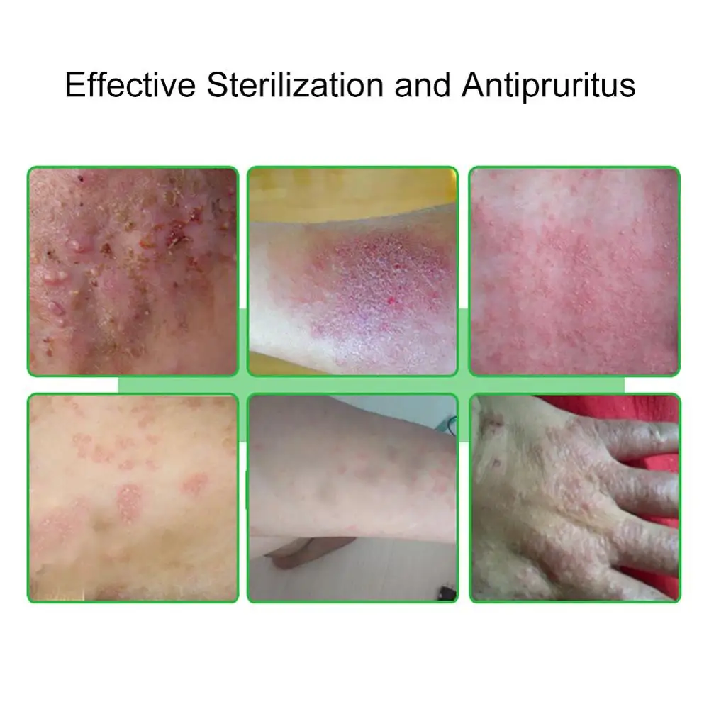 20 г крем для ухода за кожей экземы зуда вулказа псориаза системная tinea capitis