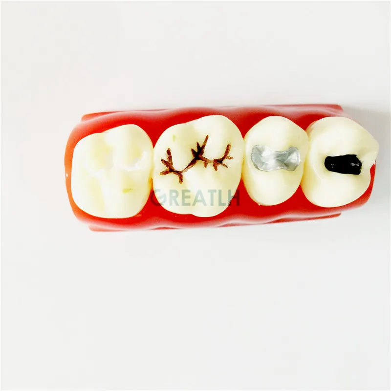 Модель для обучения стоматологии и уплотнению трещин зубов|tooth teeth|dental toothdental model