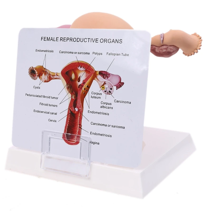 

Human Female Uterus Ovary Disease Dissection Pathology Model Biology Teaching