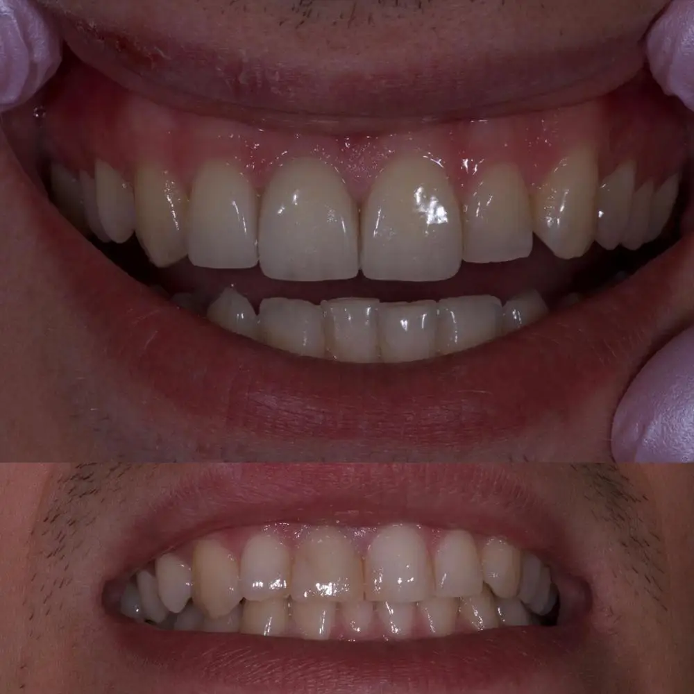 10 шт. C14 LT/HT стоматологический литиевый дисликатный блок для стоматологического