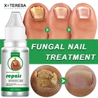 Средство для лечения грибков ногтей, эссенция для ухода за ногами, для восстановления ногтей на ногах, для удаления грибка на ногтях, антиинфекционный гель для лечения паронихии и онихомикоза