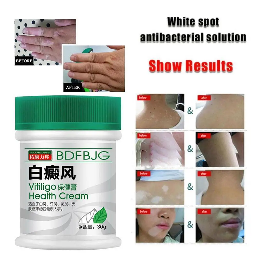Мазь Sumifun китайская для Vitiligo дневного крема 30 мл лечение симптомов рук линейка