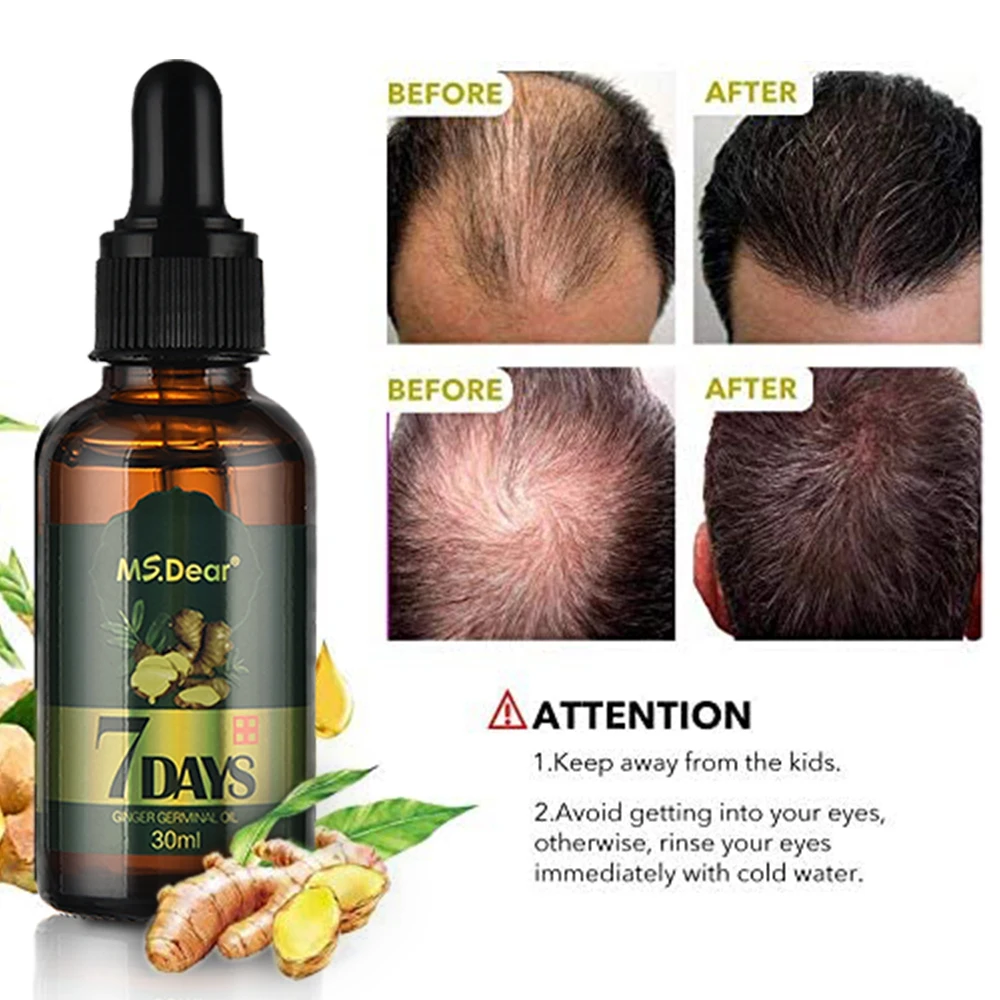 

Ginger Hair Growth Essence 7 Days Germinal Hair Growth Serum Essence Oil Hair Loss Treatment Growth Hair for Men Women