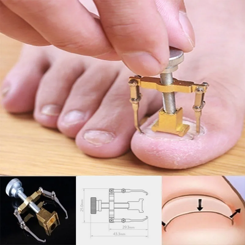 Профессиональный фиксатор вросших пальцев на ногах восстанавливающий