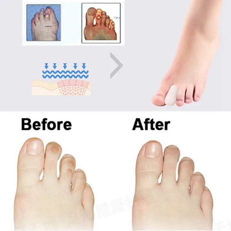 2pcs Women Feet Care Tools Silicone Tube Corns Gel Toe Blisters Bunion Protector Prevent Calluses Products | Красота и здоровье