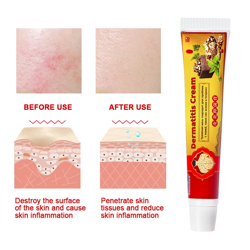 

Sumifun Psoriasis Cream Skin Care Cream Psoriasis Skin Cream Dermatitis Eczematoid Eczema Ointment Treatment 20g