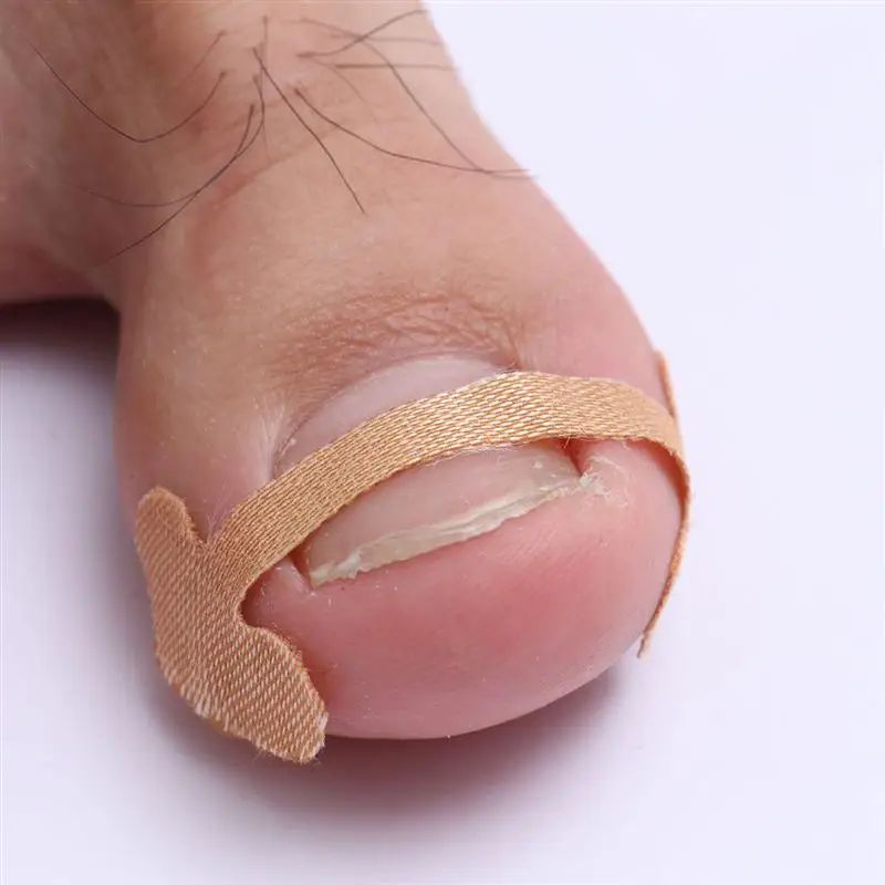 20pcs Toenail Stickers Toenail Correction Tool Ingrown Toe Nail Treatment Toenail Straightening Sticker for Home Shops