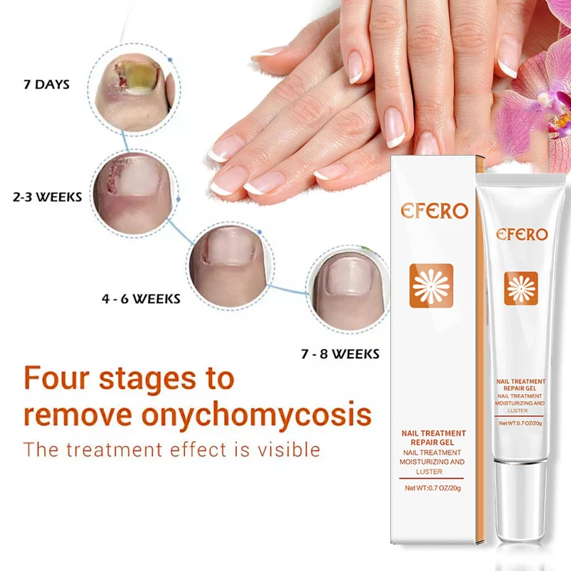

Feet Toe Fungal Nail Care Nail Repair Nail Fungus Removal Cream Onychomycosis Fungal Nail Treatment Paronychia Anti Infection