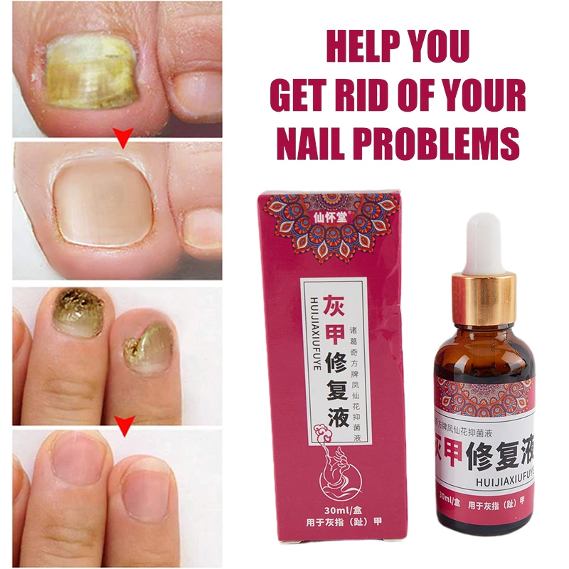 

Paronychia Onychomycosis Nail Fungal Treatment Feet Care Essence Nail Foot Whitening Toe Nail Fungus Removal Gel Anti Infection
