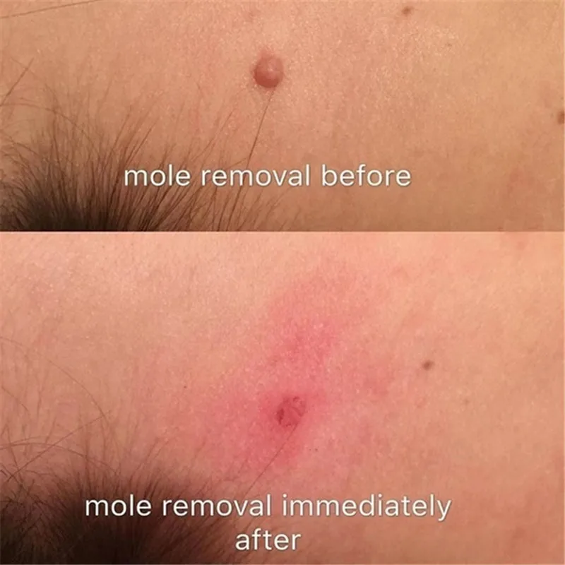 Бирка для удаления бородавок на коже средство лечения ногах натуральная