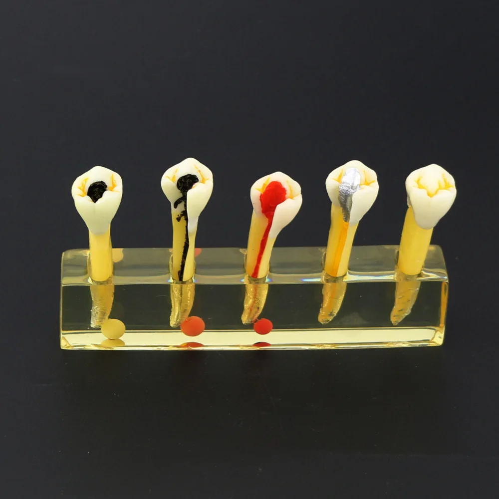 Стоматологическая 5 ступенчатая модель для эндодотического лечения корневых