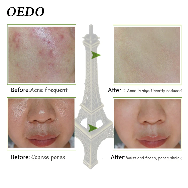 Водоросли гель алоэ вера увлажняющий отбеливающий дневной крем акне против