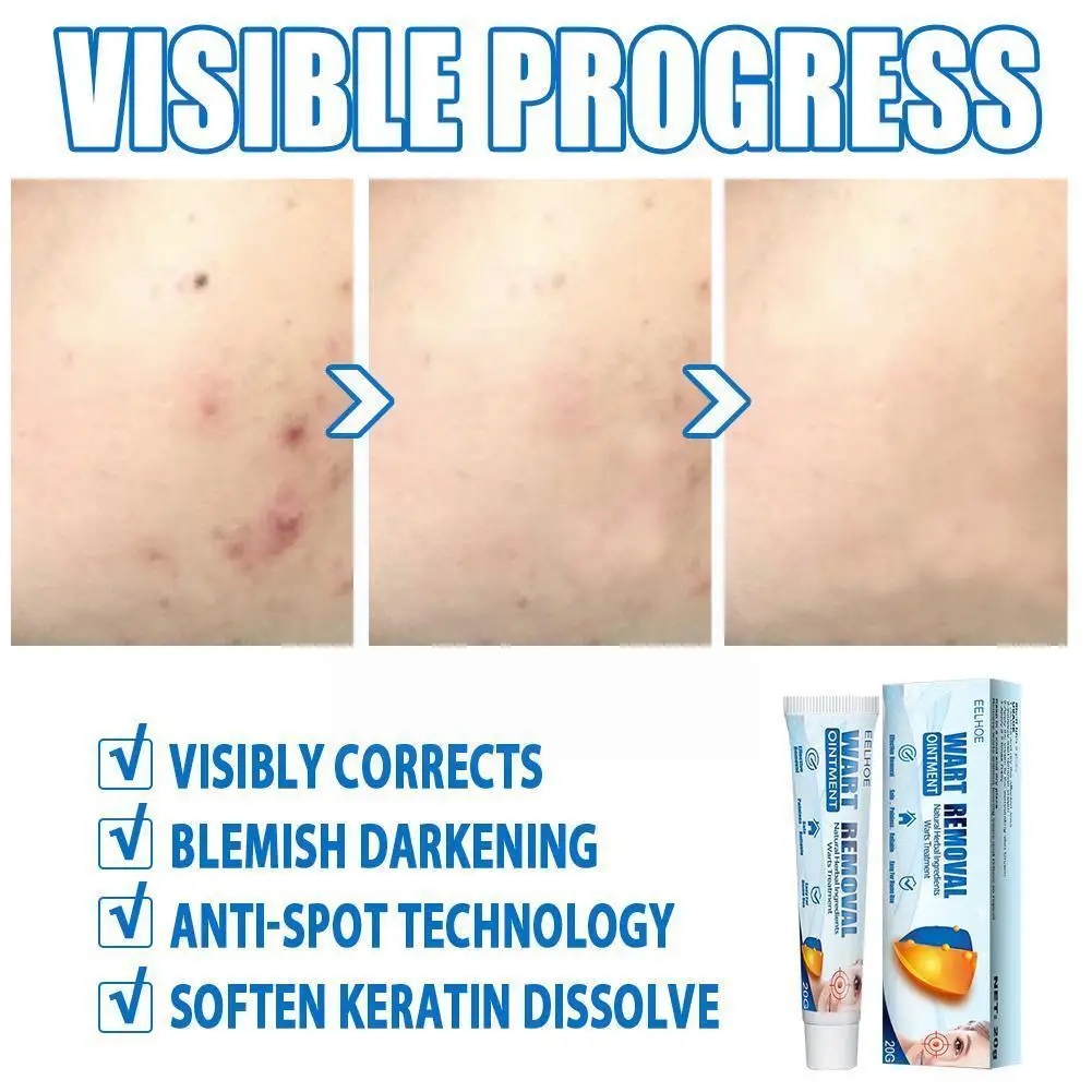 Антибактериальный крем для удаления бородавок на лице и теле 20 г |