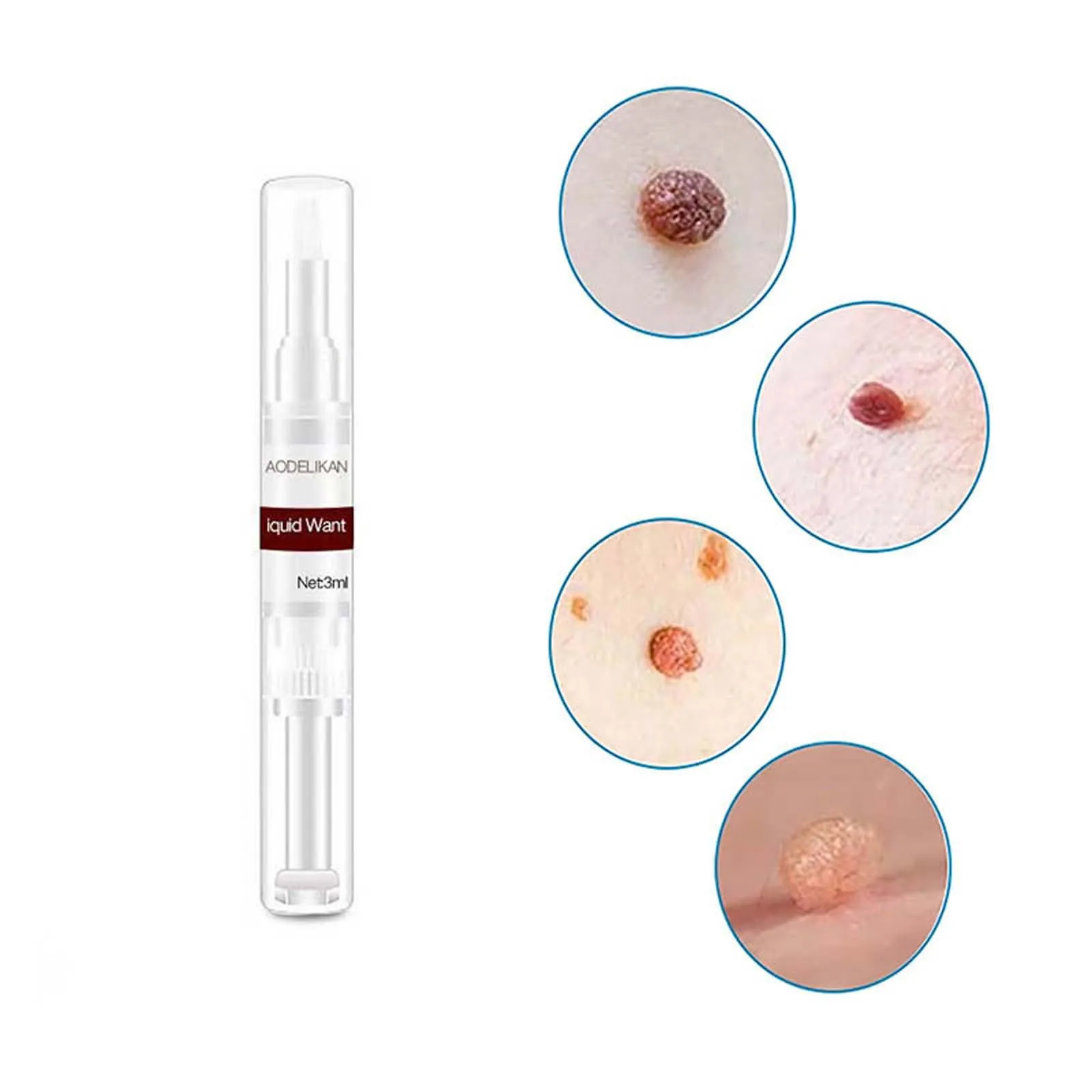 

Natural Health Skin Tag Remover12 Hours Mole Genital Wart Foot Corn Removal 3ml Fast And Effective No Odor