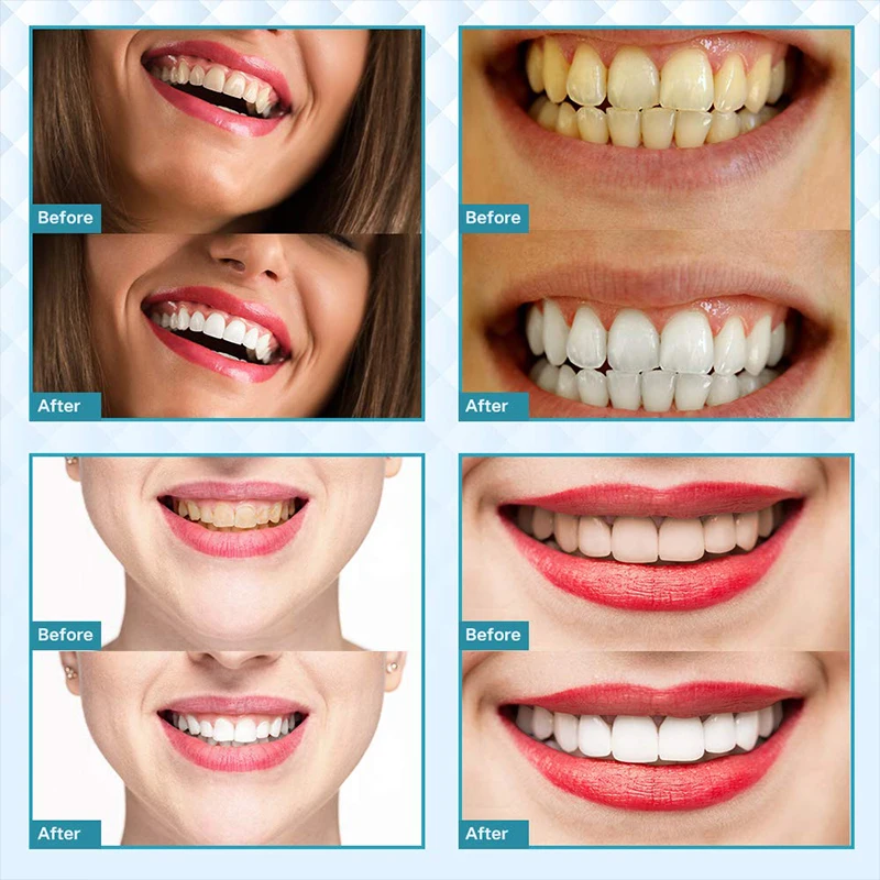 

Dental whitening Teeth Whitening Laser 3PAP Whitening Gel Dental Bleaching System Oral Gel Set Teeth Whitening veneers bleaching