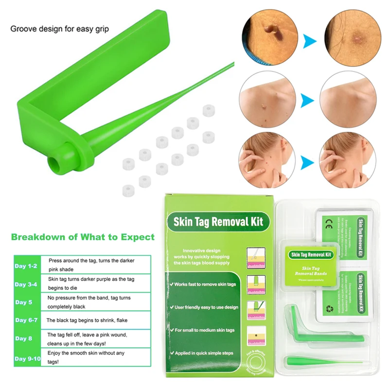 Домашний Применение микро тег для кожи Кротов средство удаления бородавок