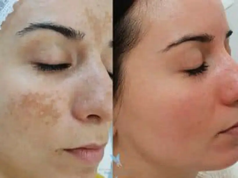 

Melasma Cream Whitening For Dark Spot Severe Anti-Acne 100% Safe Effective