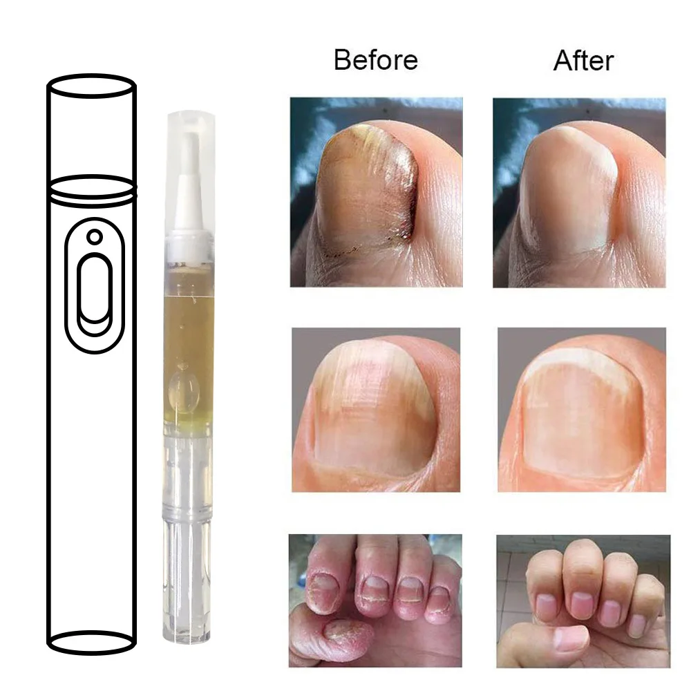 

Fungus Treatment Pen Set Nail Fungus Cream Toenail and Nail Repair Pen Toenail And Nail Care Solutions DC156