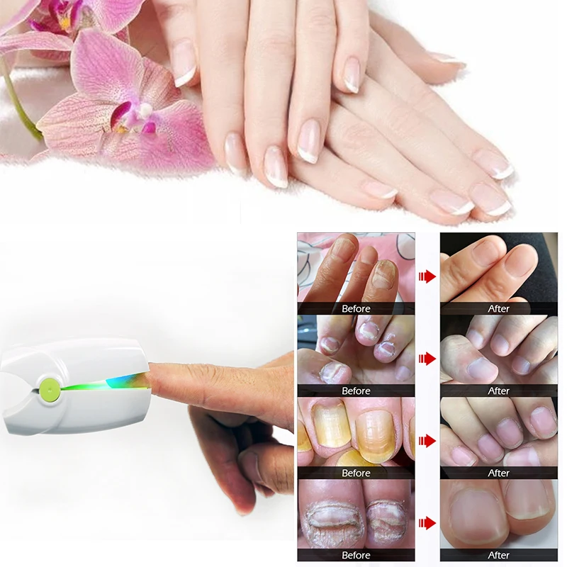 Лазерная терапия LLLT для ногтей маникюрный грибок лечение онихомикоза очистки на