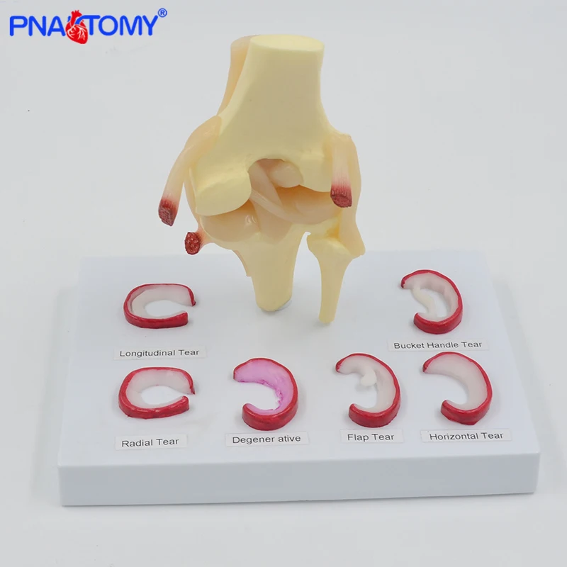 

Life Size Knee joint model with ligaments shows meniscus tears Medical Teaching Tool Anatomical Model Skeleton Anatomy