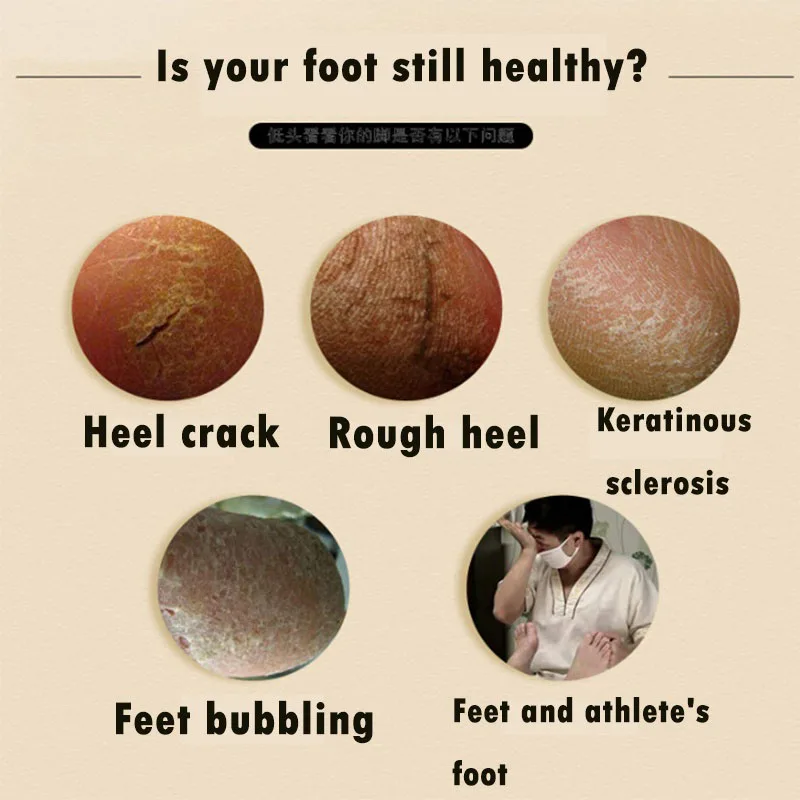 

Hot Herbal Anti-Drying Crack Foot Cream Effective Anti Fungal Moisturizing Foot Skin Care t6