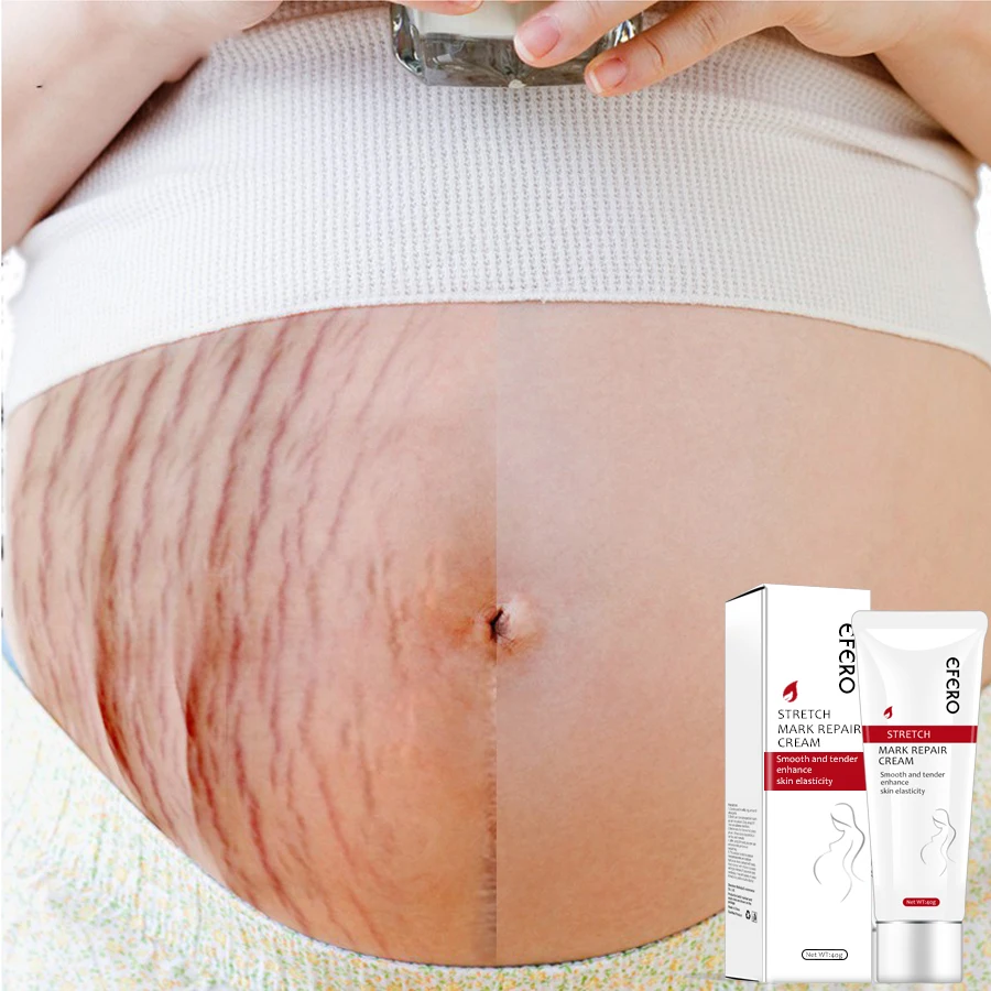 

Pregnancy Scar Removal Body Cream Pregnant Women Pigment Correction Repair Body Gel Firming Eliminate Stretch Mark Repair Cream