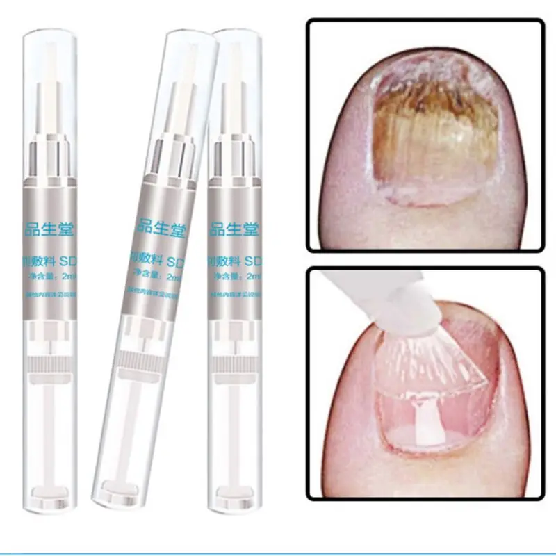 3ml Natural Herbal Toenail Fungus Nail Fungal Treatment Pen Nutrient Solution Feet Care Manicure Repair Gel Essence Tool | Красота и