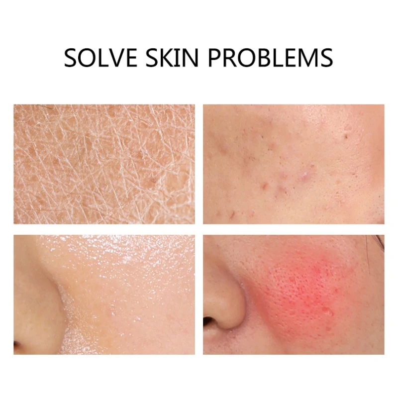 Гель алоэ вера увлажняющий противовоспалительный успокаивает кожу от акне с