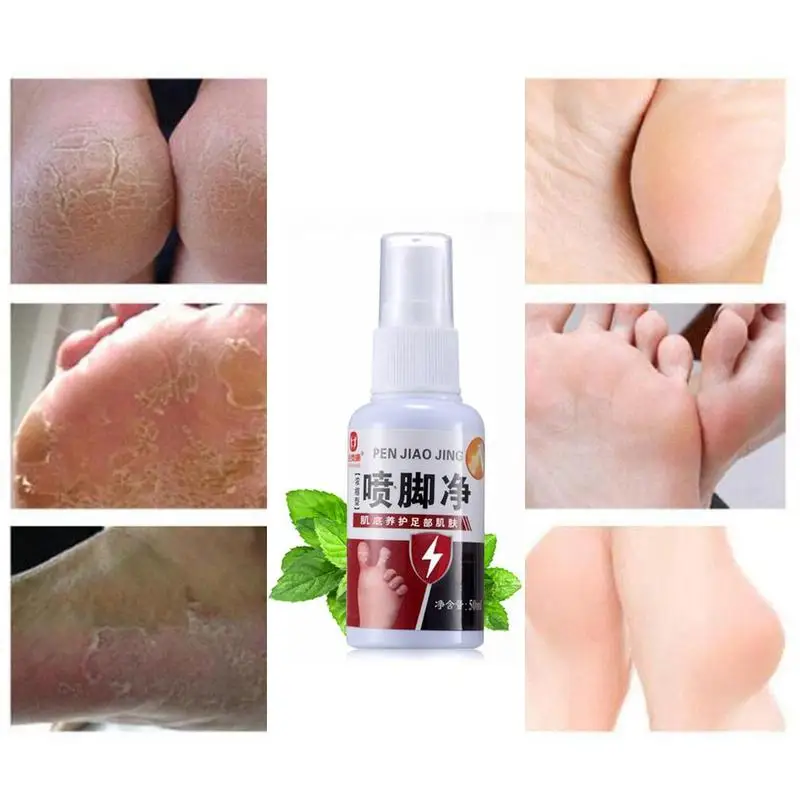 50ml Fungal Infections Foot Spray Feet Care Athlete's Odor Sweat Itching Peeling Beriber Itinea Pedis |