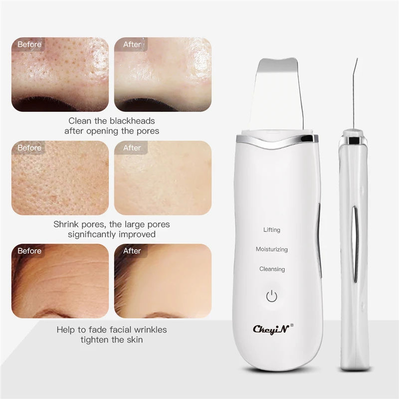 Ультразвуковой аппарат для чистки пор Высокочастотный скребок угрей устройство