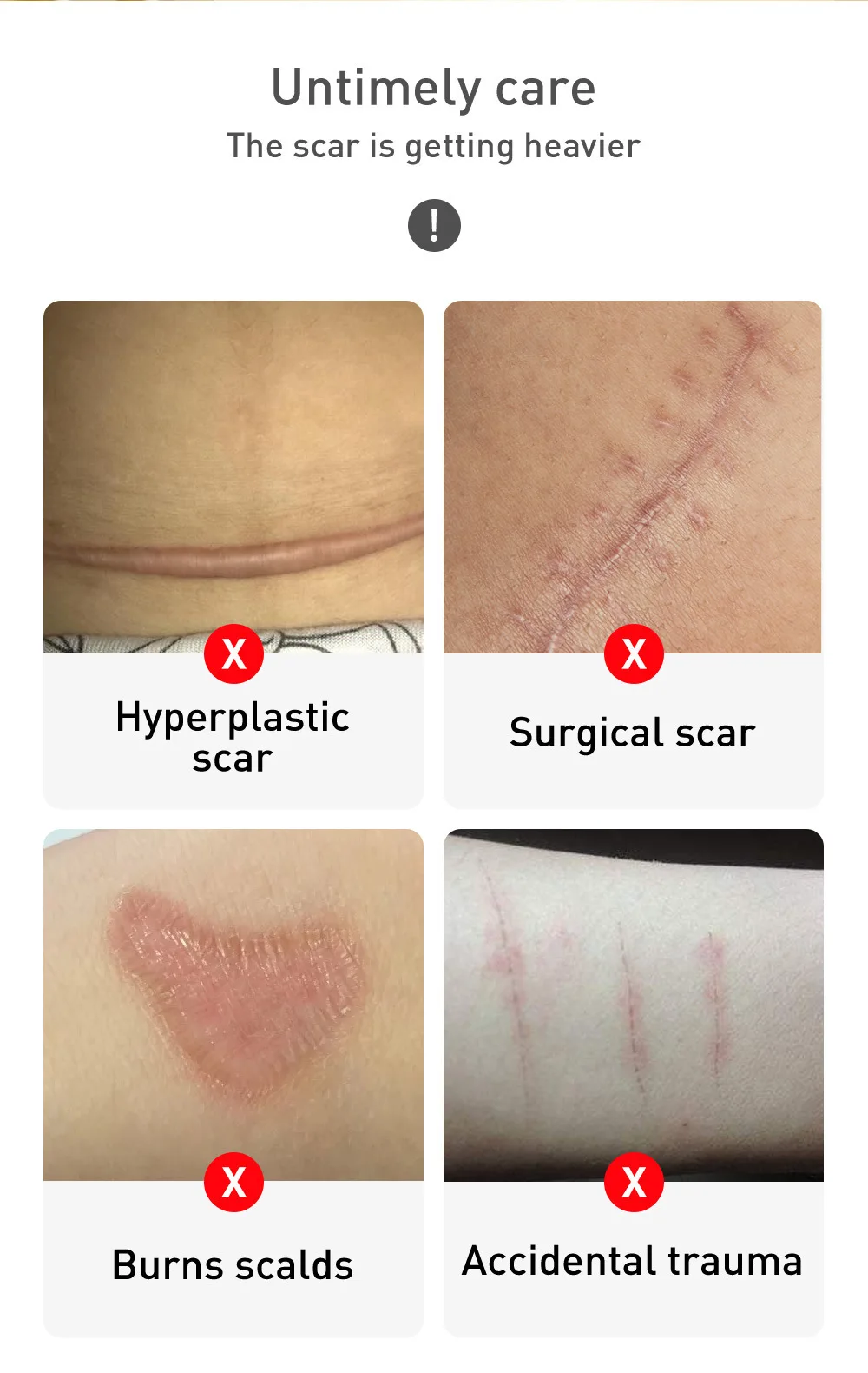 Крем для удаления шрамов от акне 30 мл | Красота и здоровье