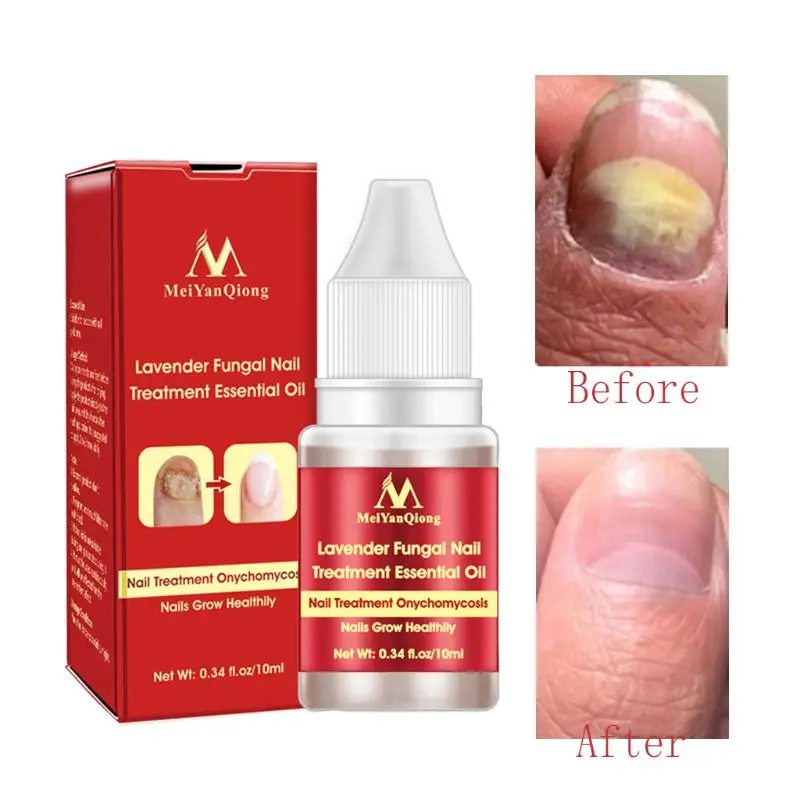 

Эссенция для восстановления ногтей, сыворотка для лечения грибковых ногтей, удаление онихомикоза, для ногтей на ногах, питательная осветля...