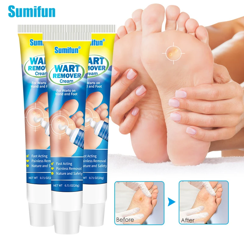 

1Pcs 20g Sumifun Wart Cream Remove Skin Tags Mole Calluses Sarcoma Ointment Foot Corn Removal Herbal Care Medical Plaster